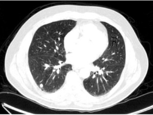 Two researchers at Harvard School of Medicine’s Brigham and Women’s Hospital used this CT lung scan to test “inattentional,” or perceptual “blindness” among radiologists in a study. Inattentional blindness is the failure to notice an unexpected stimulus that is in one’s field of vision. It occurs when other tasks are being performed which also demand attention. In the Harvard study, 83% of the radiologists failed to see the gorilla angrily shaking its fist embedded in the upper right portion of the image. This phenomenon is likely to be seen if pathologists were shown similar pathology images containing a gorilla. The Harvard researchers are now exploring ways to help diagnosticians see in ways that may reduce potential errors from failure to catch diagnostic clues hiding in plain sight. (Image copyright Trafton Drew, Ph.D., and Jeremy Wolfe, Ph.D.)